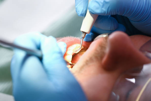 Best Emergency Dental Care for Broken or Chipped Teeth in Athens, IL