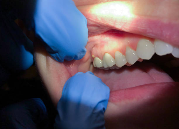 Best Urgent Care for Lost Fillings or Crowns in Athens, IL